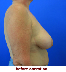 plastic-surgery-breast-lift-augmentation